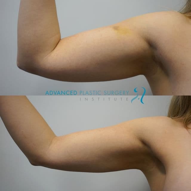 Our patient is just 6 weeks post op from her arm liposuction procedure!