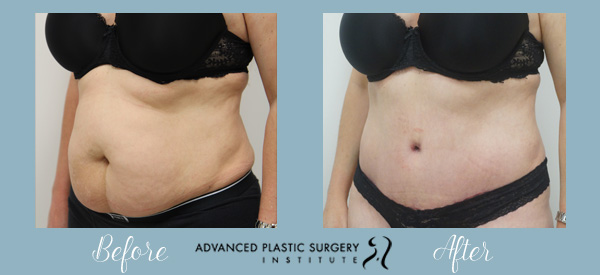 Abdominoplasty Post Pregnancy Before & After