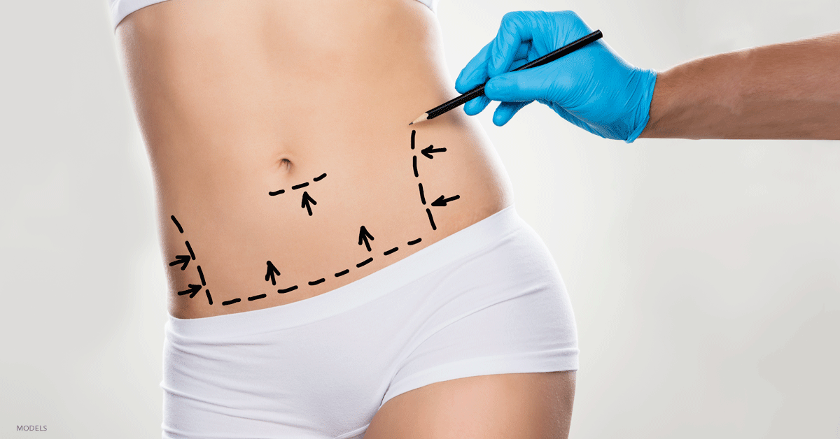 What Is a Mini Tummy Tuck in Chandler, AZ, and Is It Right for Me