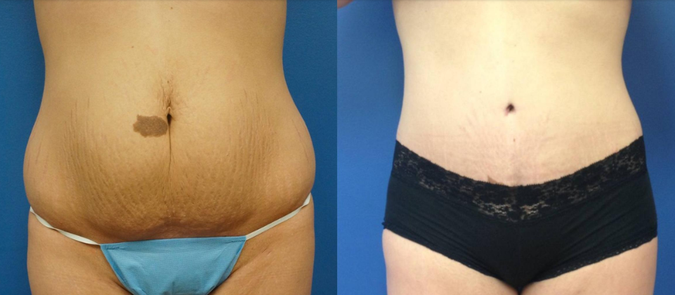 How To Spot Best Tummy Tuck Results in Before and After Photos – Josh  Olson, MD