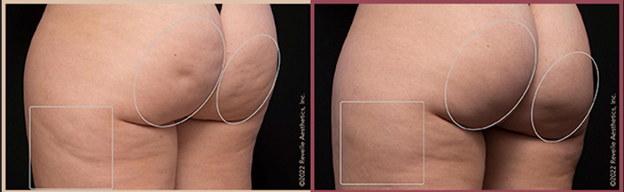 Buttocks before and after treatment